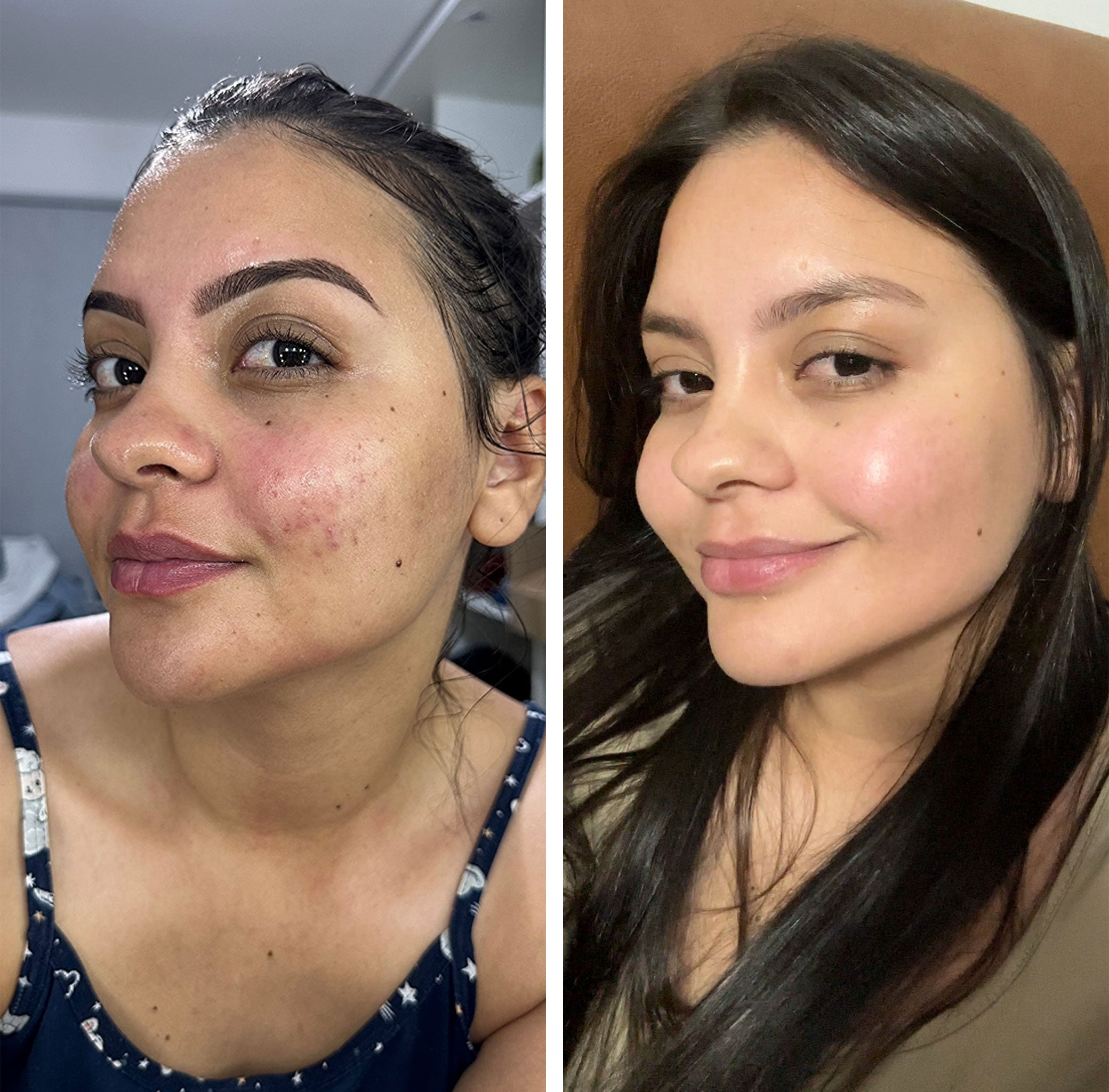 Antes e Depois Clareamento de Axilas e Virilha